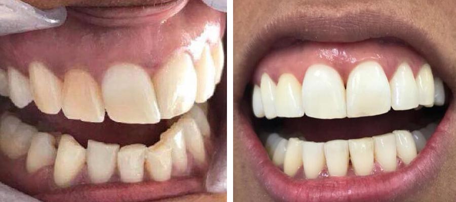 invisalign-before-after-1 invisalign before and after treatment