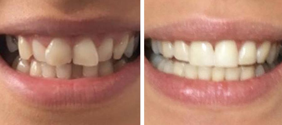 invisalign-before-after-2 invisalign before and after 2