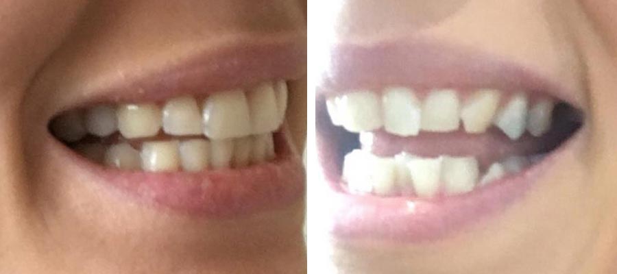 invisalign-before-after-3 invisalign before and after