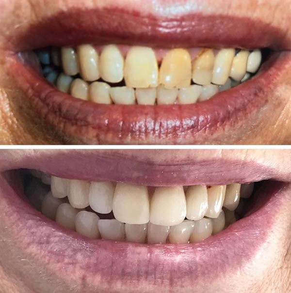 teeth-whitening-before-and-after teeth whitening before and after