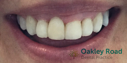 invisalign-after-5 invisalign patient after