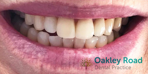 invisalign-after-6 invisalign patient after