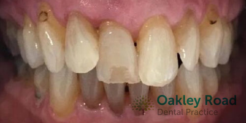 invisalign-before-1 Invisalign Before