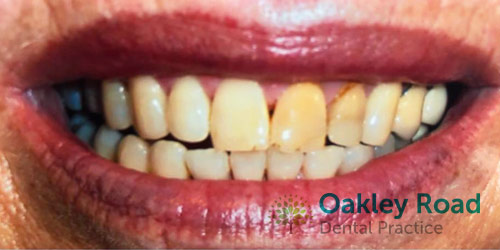 invisalign-before-6 invisalign patient before