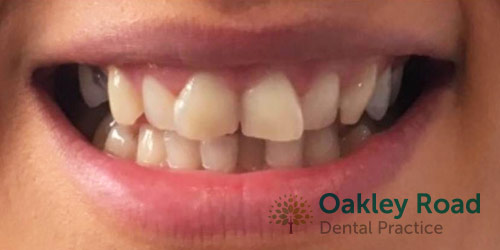 invisalign-before-9 invisalign before