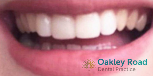 veneers-after-1 veneers after