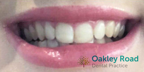 veneers-before-1 veneers before