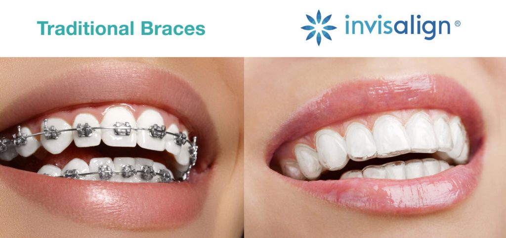 Invisalign Patient Diary Oakley Road Dental Practice 