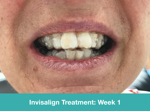 Invisalign Patient Diary - Oakley Road Dental Practice