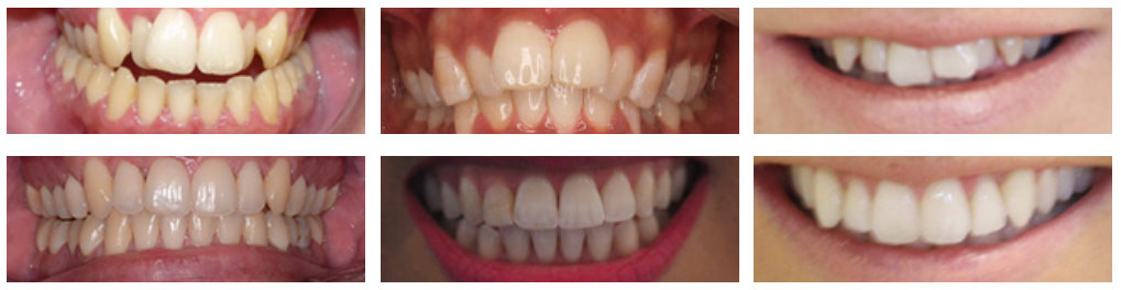 invisalign results