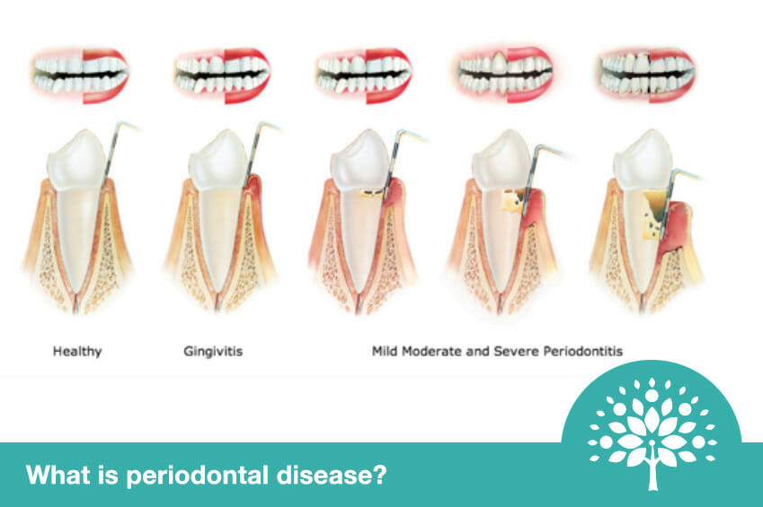 What is periodontal disease